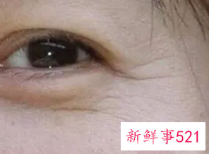 皱纹和细纹哪个更严重