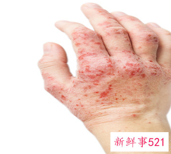 热水洗澡皮肤痒起红点