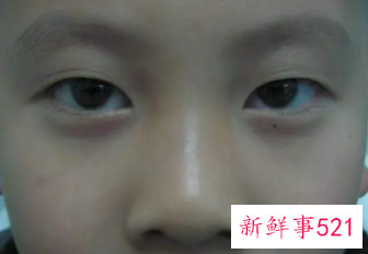 宝宝眼圈发黑要怎么办