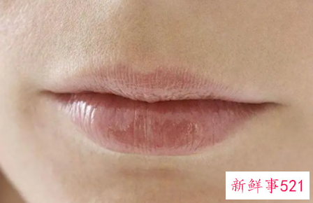 一勺盐两勺糖去唇毛有用吗