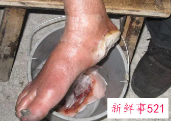 梦见自己身体溃烂流血