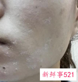 脸上干的起白皮该怎么办