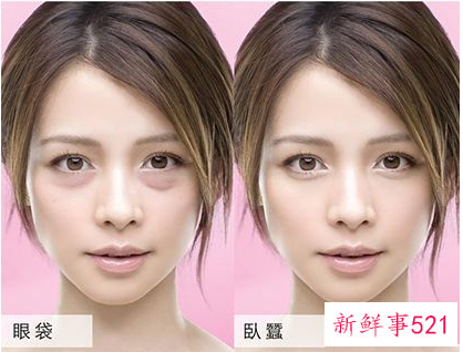 天生遗传眼袋怎么消除