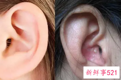 耳朵上长疙瘩是怎么回事