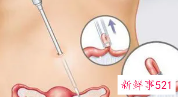 上环对身体的危害有哪些不上环怎么避孕