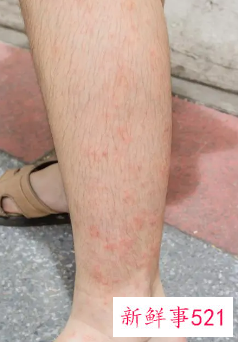 天气冷皮肤瘙痒