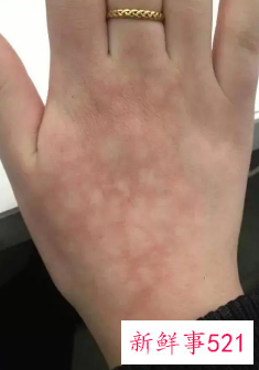 天气冷皮肤瘙痒