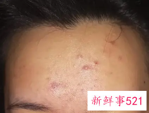 脸经常长痘痘怎么调理