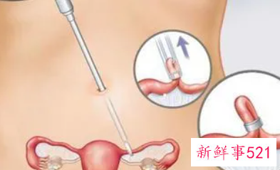 女人什么时候上环最好