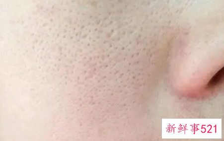 毛孔粗大该怎么办
