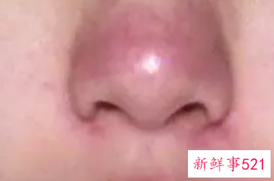 鼻子两侧老是掉皮发红