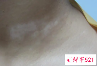 黑色素减退白斑医生说不用管