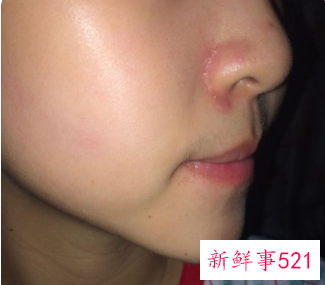 鼻子两侧老是掉皮发红