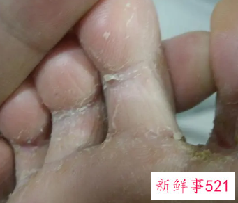 小孩脚脱皮还痒怎么回事