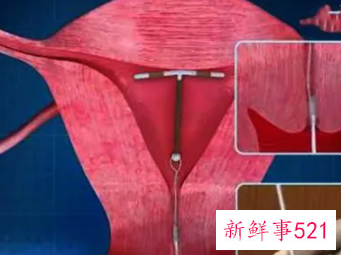 女人什么时候上环最好