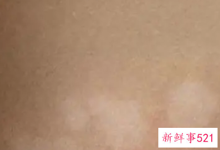 黑色素减退白斑医生说不用管