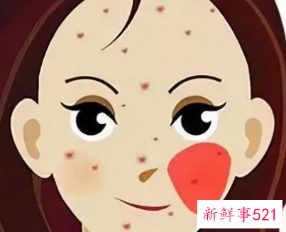 额头眉心起痘痘是什么原因