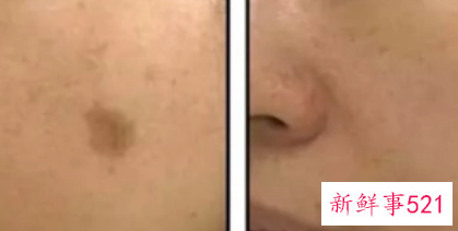 晒斑和黄褐斑的区别在哪里