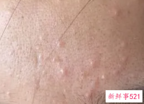 额头眉心起痘痘是什么原因