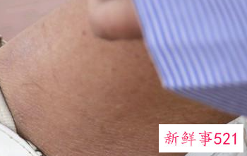 毛孔粗大该怎么办