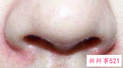 鼻子两侧老是掉皮发红