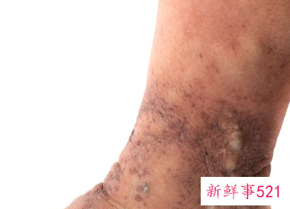 黑色素减退白斑医生说不用管