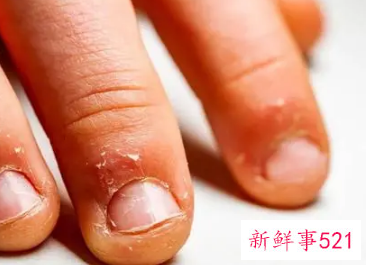 小孩喜欢咬手指甲是缺什么