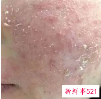 嘴角两边周围有白皮屑
