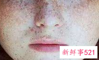 长雀斑的人最好不要吃什么