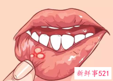 口腔溃疡怎么办呢