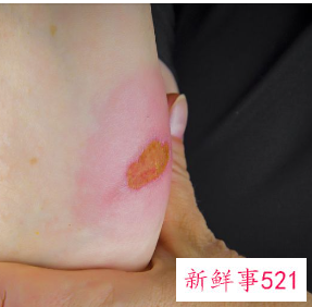 烫伤起泡怎么处理偏方