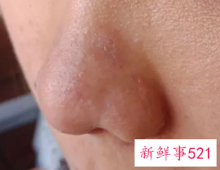 梦见鼻子脱皮