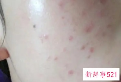 如何不长青春痘