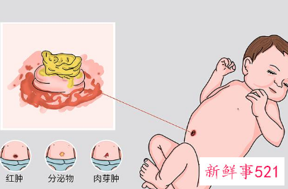为什么脐炎反复发作
