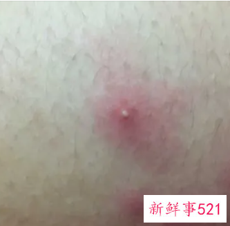 腿上长了有脓的痘痘越来越痛