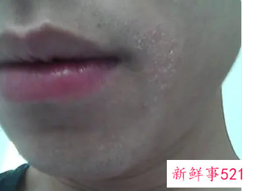 嘴角两边周围有白皮屑