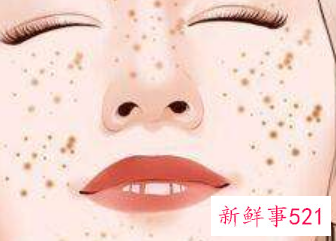 长雀斑的人最好不要吃什么