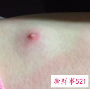 腿上长了有脓的痘痘越来越痛