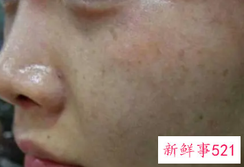 脸上有雀斑怎么去除有效