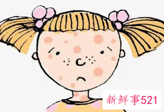 女孩长青春痘怎么办