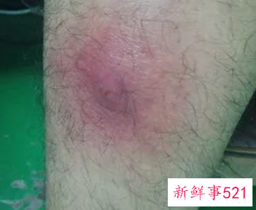 腿上长了有脓的痘痘越来越痛