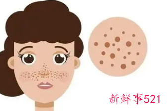 脸颊两侧长斑怎么办