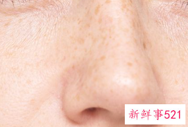 脸上有雀斑怎么去除有效
