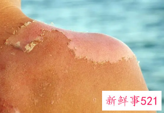 太阳晒伤后如何修复