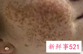 长雀斑的人最好不要吃什么