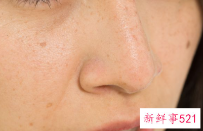 脸上有雀斑怎么去除有效