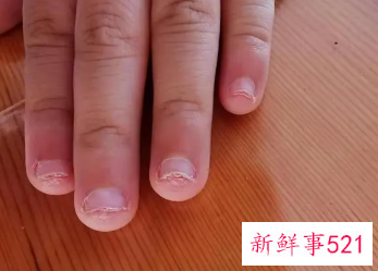 小孩喜欢咬手指甲是缺什么