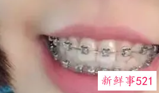 梦见牙套是什么意思