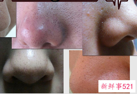 轻松去黑头的5个独门秘方