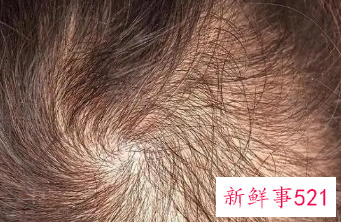 头发少的人真的有福吗